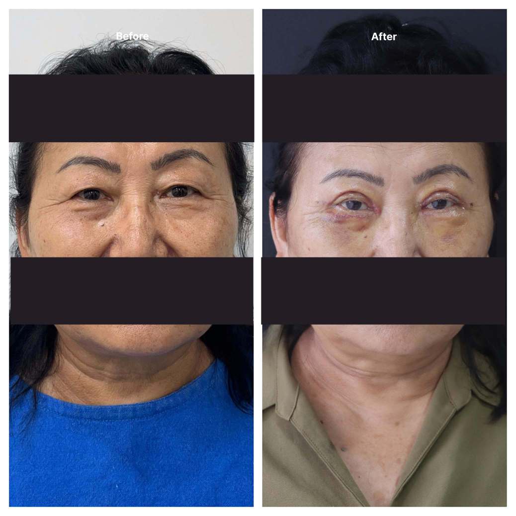 Eyelid Surgery KOQ10